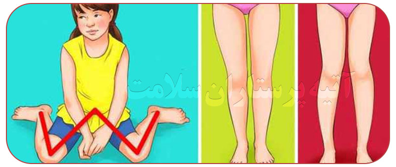عوارض ناشی از نشستن کودک به حالت w