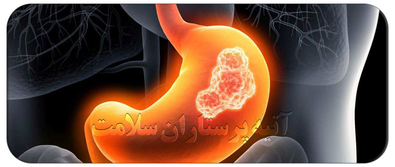 سرطان معده ، علائم ، شناسایی و راه های جلوگیری