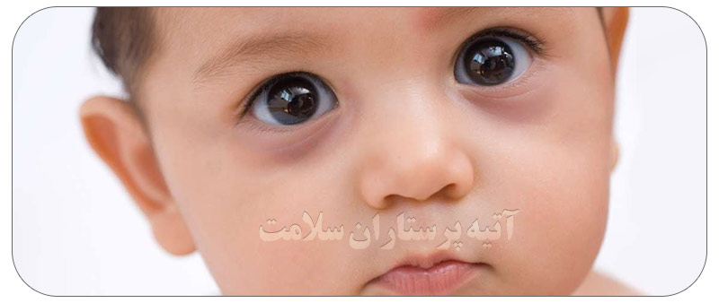 علت کبودی زیر چشم کودکان کبودی زیر چشمان کودکان درمان - علت کبودی زیر چشم کودکان